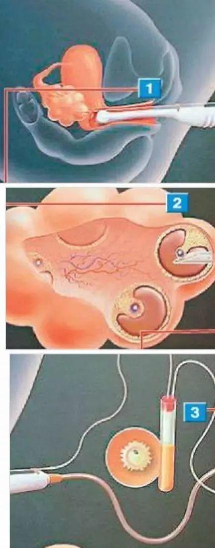 借卵试管代怀方式有哪些_借卵试管代怀：方式解析